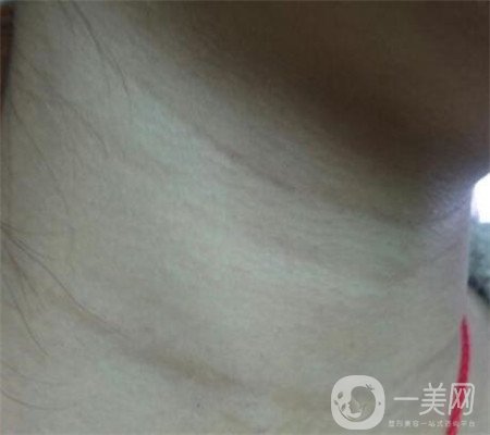 頸部除皺多少錢？會(huì)不會(huì)很貴？