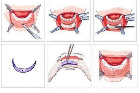 隆下巴假體歪了可以修復(fù)嗎？