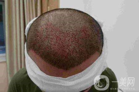 毛發(fā)種植費(fèi)用大概要多少錢？