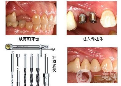 湖州種植牙多少錢(qián) 
