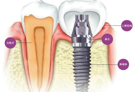 湖州種植牙多少錢(qián) 