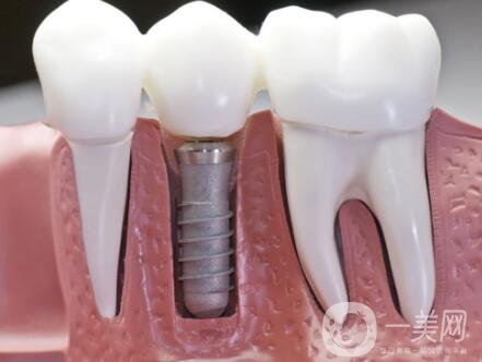 湖州種植牙多少錢(qián) 