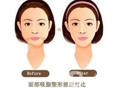 面部抽脂之后皮膚會(huì)變得松弛嗎？