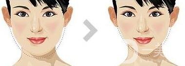 面部抽脂之后皮膚會(huì)變得松弛嗎？