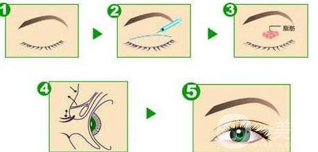 重慶哪里割雙眼皮比較好?選擇正規(guī)機構(gòu)認(rèn)準(zhǔn)這幾點!