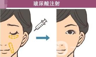注射玻尿酸危害大嗎?有沒有毀容的風(fēng)險?