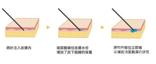 注射透明質酸疼嗎?需要注意什么?