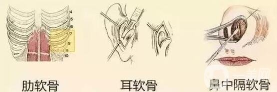 自體軟骨隆鼻費(fèi)用貴嗎?要多少錢?