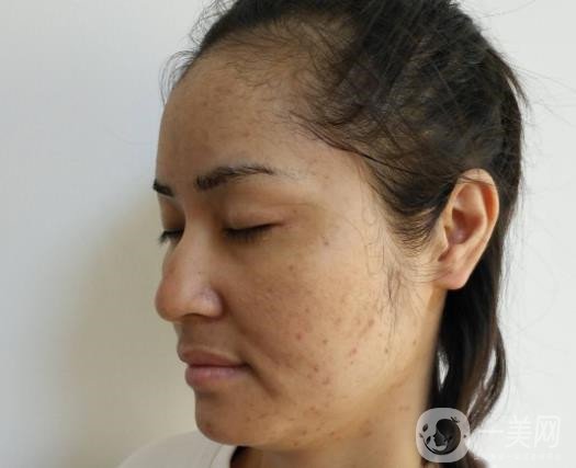 激光祛斑祛痘的后遺癥，你知道嗎？