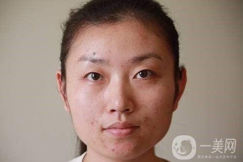 激光祛斑祛痘的后遺癥，你知道嗎？