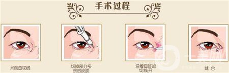 韓式開眼角多少錢？普遍價(jià)位是多少？