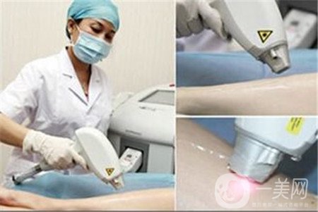 激光脫毛好嗎？有副作用嗎？