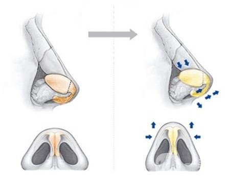 哪些人不適合硅膠隆鼻？禁忌人群是哪些？