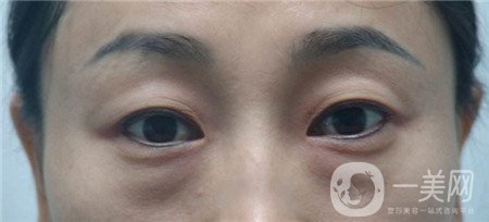 內切去眼袋多長時間恢復?期間需要注意什么?