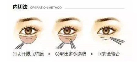 內切去眼袋多長時間恢復?期間需要注意什么?