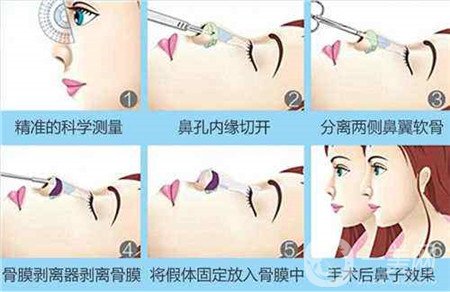 膨體隆鼻術(shù)后注意事項(xiàng)有哪些？需要忌口嗎？