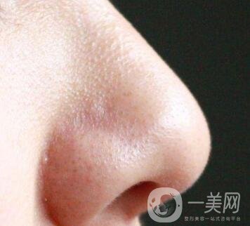 鼻子長黑頭怎么辦？做激光有用嗎？