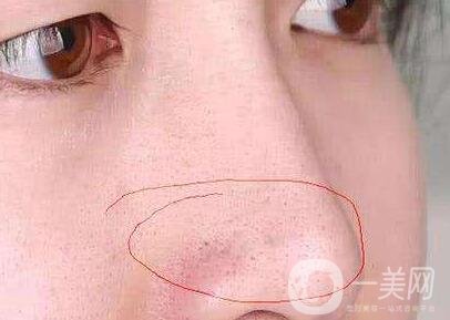 鼻子長黑頭怎么辦？做激光有用嗎？