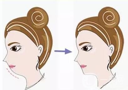 剛做完*注意什么?護(hù)理小知識(shí)