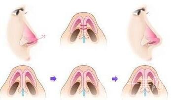 剛做完*注意什么?護(hù)理小知識(shí)