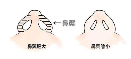 怎么縮小鼻翼?縮小鼻翼的方法有哪些?