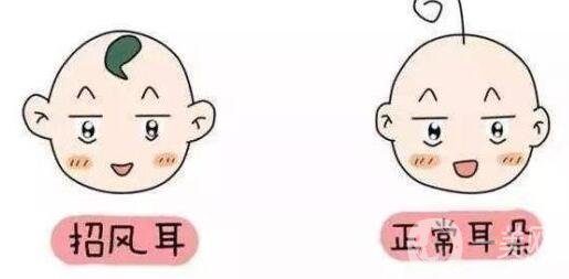 招風(fēng)耳整形多少歲做比較合適?