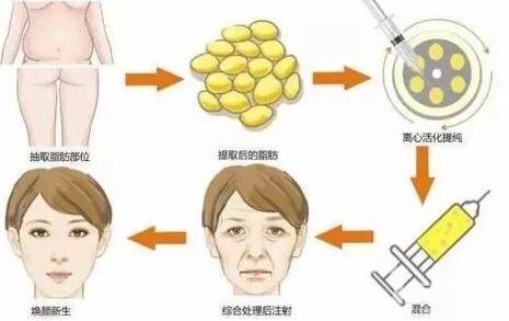 自體脂肪填充多少錢?怎么收費(fèi)的?