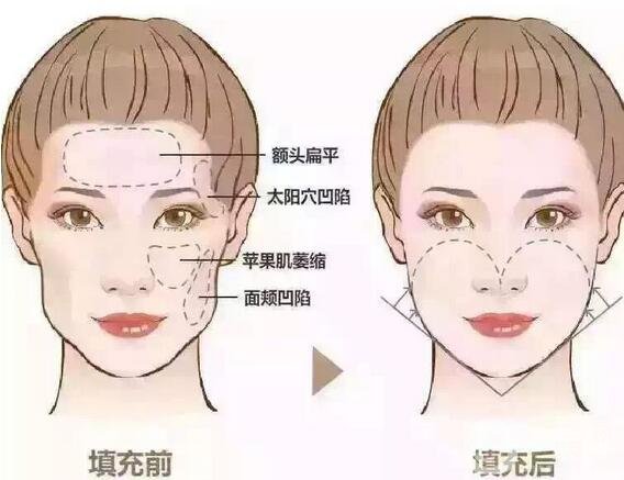 自體脂肪填充面部后注意事項有哪些?