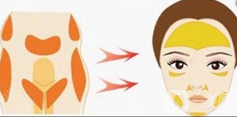 面部自體脂肪填充