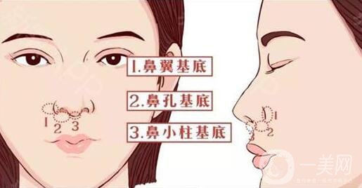 在韓國做鼻子要多少錢?比國內的貴嗎?