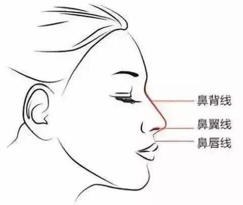 硅膠隆鼻一定會下滑嗎?下滑了怎么辦?