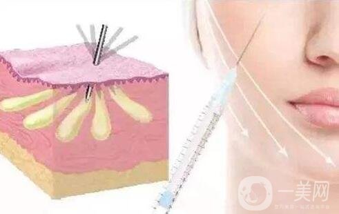 自體脂肪填充能保持多少年?能終身保持嗎?