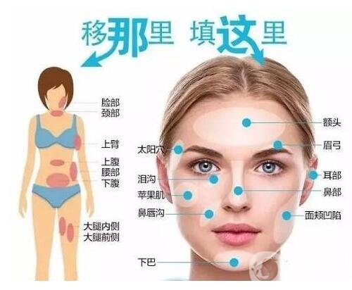 自體脂肪填充面部多少錢?大概價(jià)位是多少?