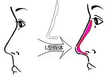 假體隆鼻整形手術