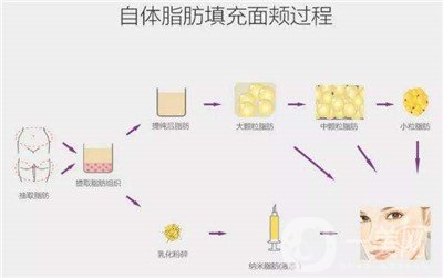 北京自體脂肪填充醫(yī)院有哪些？好的有哪些？
