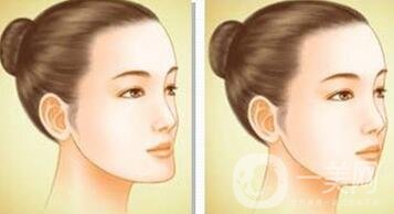 下巴突出怎么整？矯正手術(shù)原來是這么做的