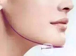 下巴突出怎么整？矯正手術(shù)原來是這么做的