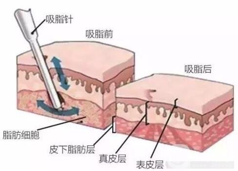上臂吸脂減肥術(shù)靠譜嗎?能細多少?