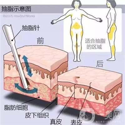 腰腹環(huán)吸后要腫多長時間呢？可以活動嗎？