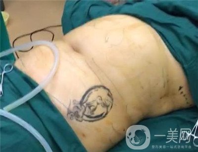 腰腹環(huán)吸后要腫多長時間呢？可以活動嗎？