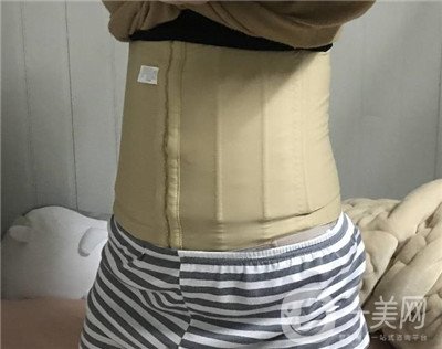腰腹環(huán)吸后要腫多長時間呢？可以活動嗎？