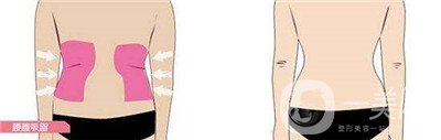  腰腹吸脂后多久消腫？多久可以開(kāi)始工作？