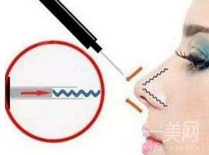 自體軟骨隆鼻整形疼嗎？*嗎？