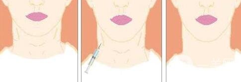 注射除皺新方法有哪些?*果怎么樣?