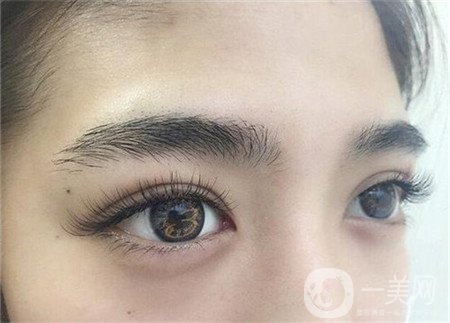 眼部提升手術(shù)怎么做？多久恢復(fù)？