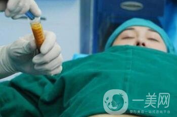 抽脂隆胸手術費用貴嗎？多少錢？