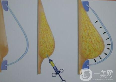 自體脂肪填充豐胸的價格要多少錢?