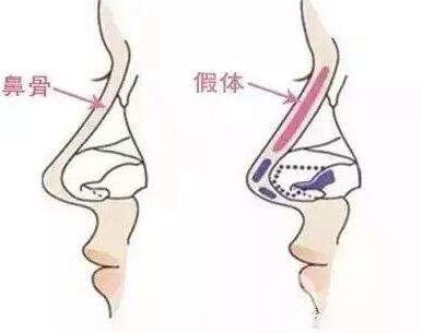 假體隆鼻需要多少錢?進口的要多少錢?