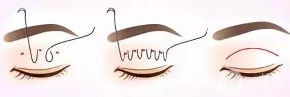 割雙眼皮過程大概需要多長時間?