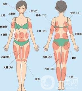 全身吸脂減肥價格